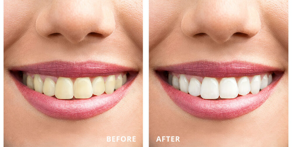 Northgate Dental Sinsational Smile Teeth Whitening Before After Kohler Dentistry 