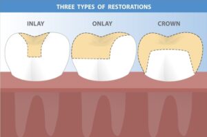 Inlays and Onlays