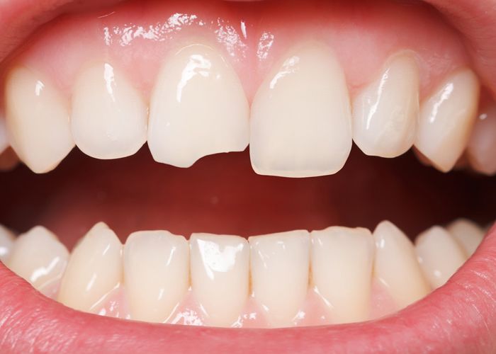 Best Treatments for Chipped Teeth