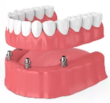 Dental Implant Dentures - Chicago, IL - Wilmette, IL - Dr. Craig Kohler